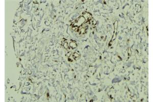 ABIN6272857 at 1/100 staining Human breast cancer tissue by IHC-P. (VPRBP antibody)