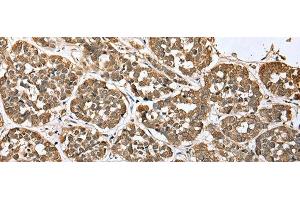 Immunohistochemistry of paraffin-embedded Human esophagus cancer tissue using ATXN7L3 Polyclonal Antibody at dilution of 1:35(x200) (ATXN7L3 antibody)