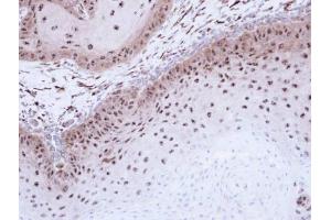 IHC-P Image Immunohistochemical analysis of paraffin-embedded Cal27 xenograft , using DMC1, antibody at 1:500 dilution. (DMC1 antibody  (Center))