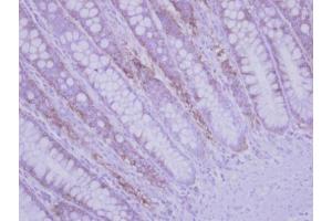 IHC-P Image Immunohistochemical analysis of paraffin-embedded human colon carcinoma, using RPLP2, antibody at 1:500 dilution. (RPLP2 antibody  (Center))