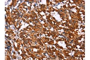 The image on the left is immunohistochemistry of paraffin-embedded Human thyroid cancer tissue using ABIN7190857(GPR65 Antibody) at dilution 1/15, on the right is treated with synthetic peptide.