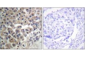 Immunohistochemistry analysis of paraffin-embedded human breast carcinoma tissue, using PLC beta3 (Ab-537) Antibody. (PLCB3 antibody  (AA 503-552))