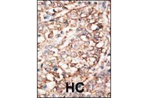 Formalin-fixed and paraffin-embedded human cancer tissue reacted with the primary antibody, which was peroxidase-conjugated to the secondary antibody, followed by AEC staining. (BMPR1A antibody  (C-Term))