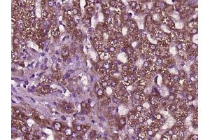 Paraformaldehyde-fixed, paraffin embedded human liver cancer, Antigen retrieval by boiling in sodium citrate buffer (pH6) for 15min, Block endogenous peroxidase by 3% hydrogen peroxide for 30 minutes,  Blocking buffer (normal goat serum) at 37°C for 20min, Antibody incubation with SCD1 Polyclonal Antibody (bs-3787R) at 1:400 overnight at 4°C, followed by a conjugated secondary and DAB staining. (SCD antibody  (AA 265-359))