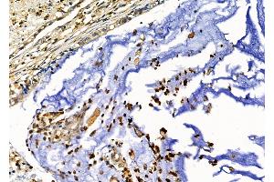 ABIN6257408 and ABIN6276235 at 1/100 staining Human gastric cancer by IHC-P. (VIPR2 antibody  (Internal Region))