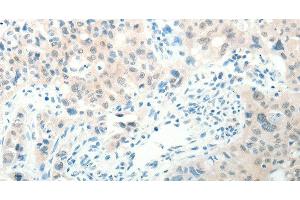 Immunohistochemistry of paraffin-embedded Human lung cancer tissue using RAB25 Polyclonal Antibody at dilution 1:50
