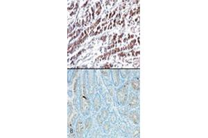 IHC testing using HTRA2 monoclonal antibody, clone 196C429  shows cytoplasmic staining in stomach tumor tissue (A) and very weak staining in normal stomach tissue (B) . (HTRA2 antibody  (AA 335-350))