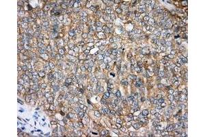 Immunohistochemical staining of paraffin-embedded Adenocarcinoma of colon tissue using anti-BTK mouse monoclonal antibody. (BTK antibody)