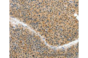 Immunohistochemistry of Human brain  using ACLY Polyclonal Antibody at dilution of 1:40 (ACLY antibody)