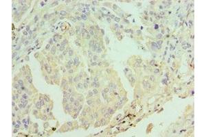 Immunohistochemistry of paraffin-embedded human lung cancer using ABIN7171956 at dilution of 1:100
