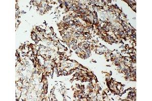 IHC-P: Apoptosis-Inducing Factor antibody testing of human lung cancer tissue (AIF antibody  (C-Term))