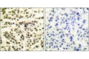 Immunohistochemistry analysis of paraffin-embedded human breast carcinoma tissue, using MAPKAPK2 (Ab-334) Antibody. (MAPKAP Kinase 2 antibody  (AA 300-349))