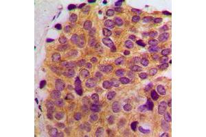 Immunohistochemical analysis of MAST2 staining in human breast cancer formalin fixed paraffin embedded tissue section. (MAST2 antibody  (Center))