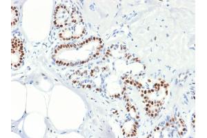 Formalin-fixed, paraffin-embedded human Breast Carcinoma stained with Estrogen Receptor, alpha Mouse Recombinant Monoclonal Antibody (rESR1/1935). (Recombinant Estrogen Receptor alpha antibody)