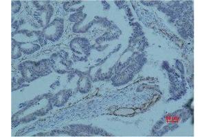 Immunohistochemistry (IHC) analysis of paraffin-embedded Human Colon Carcicnoma using Survivin Monoclonal Antibody. (Survivin antibody)