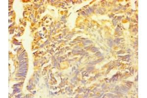Immunohistochemistry of paraffin-embedded human ovarian cancer using ABIN7153564 at dilution of 1:100 (SNCG antibody  (AA 1-127))