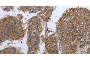 Immunohistochemistry of paraffin-embedded Human liver cancer tissue using PDIA2 Polyclonal Antibody at dilution 1:50 (PDIA2 antibody)