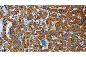 Immunohistochemistry of paraffin-embedded Human thyroid cancer tissue using FLCN Polyclonal Antibody at dilution 1:40 (FLCN antibody)