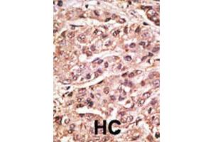 Formalin-fixed and paraffin-embedded human hepatocellular carcinoma tissue reacted with the SUMO4 polyclonal antibody  , which was peroxidase-conjugated to the secondary antibody, followed by DAB staining. (SUMO4 antibody  (Val55))