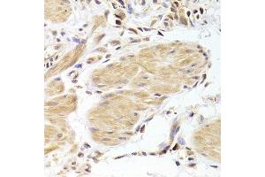 Immunohistochemistry of paraffin-embedded human gastric cancer using CASP2 Antibody. (Caspase 2 antibody  (AA 153-452))