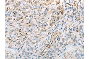 The image on the left is immunohistochemistry of paraffin-embedded Human gastic cancer tissue using ABIN7191692(NPPC Antibody) at dilution 1/70, on the right is treated with synthetic peptide. (NPPC antibody)