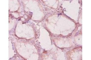 Immunohistochemistry of paraffin-embedded human colon cancer using ABIN7155314 at dilution of 1:20 (HDAC4 antibody  (AA 1-227))