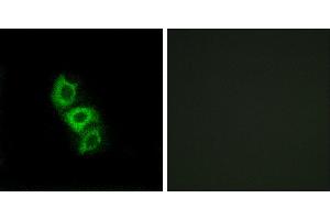 Peptide - +Immunohistochemistry analysis of paraffin-embedded human liver carcinoma tissue using APOL5 antibody.
