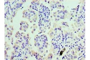 Immunohistochemistry of paraffin-embedded human lung cancer using ABIN7147984 at dilution of 1:100 (COTL1 antibody  (AA 1-142))