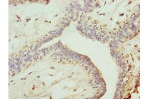 Immunohistochemistry of paraffin-embedded human breast cancer using ABIN7151243 at dilution of 1:100