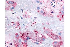 Anti-RARB antibody IHC of human intermediate trophoblasts. (Retinoic Acid Receptor beta antibody  (C-Term))