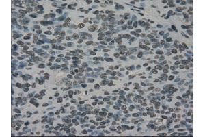 Immunohistochemical staining of paraffin-embedded Carcinoma of bladder tissue using anti-PRKYmouse monoclonal antibody. (PRKY antibody)