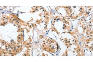 Immunohistochemistry of paraffin-embedded Human thyroid cancer tissue using UGCG Polyclonal Antibody at dilution 1:50