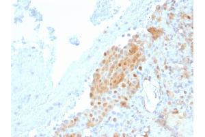 Formalin-fixed, paraffin-embedded human Mesothelioma stained with Calretinin Mouse Monoclonal Antibody (CALB2/2685).