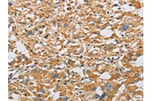 The image on the left is immunohistochemistry of paraffin-embedded Human thyroid cancer tissue using ABIN7128504(ARHGEF7 Antibody) at dilution 1/40, on the right is treated with fusion protein.