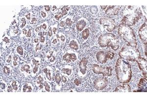 IHC-P Image Immunohistochemical analysis of paraffin-embedded human gastric cancer, using PSKH2, antibody at 1:100 dilution. (PSKH2 antibody)
