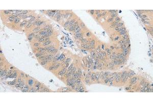Immunohistochemistry of paraffin-embedded Human colon cancer using PLPP1 Polyclonal Antibody at dilution of 1:40 (PLPP1 antibody)