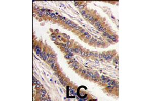 Formalin-fixed and paraffin-embedded human lung carcinoma tissue reacted with PRKX polyclonal antibody  , which was peroxidase-conjugated to the secondary antibody, followed by DAB staining. (PRKX antibody  (C-Term))
