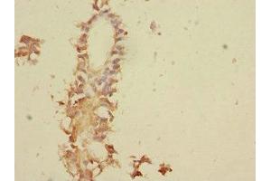 Immunohistochemistry of paraffin-embedded human breast cancer using ABIN7173776 at dilution of 1:100 (TNFAIP8 antibody  (AA 1-198))