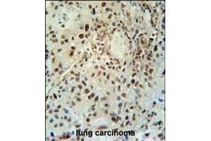 ABHEB Antibody (C-term) (ABIN653654 and ABIN2842995) immunohistochemistry analysis in formalin fixed and paraffin embedded human lung carcinoma followed by peroxidase conjugation of the secondary antibody and DAB staining.