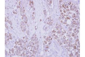 IHC-P Image Immunohistochemical analysis of paraffin-embedded human breast cancer, using CD82, antibody at 1:250 dilution.
