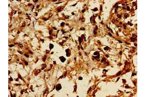 Immunohistochemistry of paraffin-embedded human melanoma using ABIN7154494 at dilution of 1:100