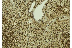 ABIN6272401 at 1/100 staining Human breast cancer tissue by IHC-P. (PRPF31 antibody  (Internal Region))