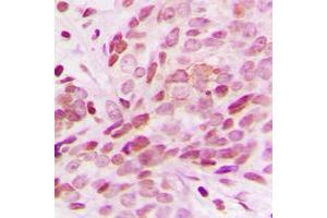 Immunohistochemical analysis of G15 staining in human breast cancer formalin fixed paraffin embedded tissue section. (AGPAT1 antibody  (Center))