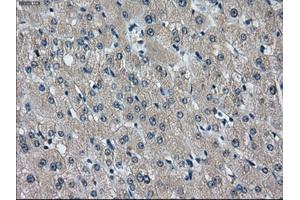 Immunohistochemical staining of paraffin-embedded liver tissue using anti-IDH3Amouse monoclonal antibody. (IDH3A antibody)