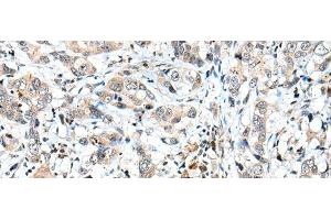 Immunohistochemistry of paraffin-embedded Human breast cancer tissue using SPCS2 Polyclonal Antibody at dilution of 1:40(x200) (SPCS2 antibody)