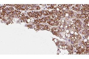 ABIN6272977 at 1/100 staining Human liver cancer tissue by IHC-P. (PTPRU antibody  (Internal Region))