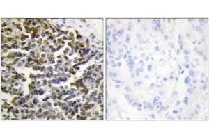 Immunohistochemistry analysis of paraffin-embedded human lung carcinoma tissue, using TCOF1 Antibody. (TCOF1 antibody  (AA 41-90))