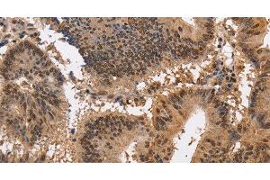 Immunohistochemistry of paraffin-embedded Human colon cancer using KCNG2 Polyclonal Antibody at dilution of 1:40 (Kcng2 antibody)