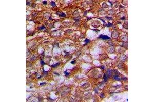 Immunohistochemical analysis of Alpha-tubulin staining in human prostate cancer formalin fixed paraffin embedded tissue section. (alpha Tubulin antibody  (C-Term))