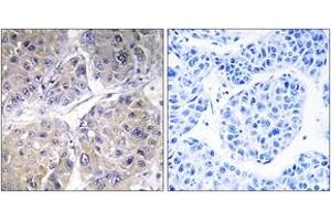 Immunohistochemistry analysis of paraffin-embedded human liver carcinoma tissue, using SLC27A5 Antibody. (SLC27A5 antibody  (AA 481-530))